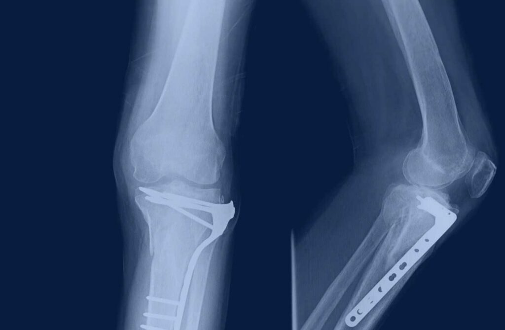 X-ray of a leg with orthopedic implants, highlighting EPTAM's expertise in medical device manufacturing